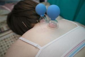 a médico faz a paciente acupuntura e vácuo massagem. foto