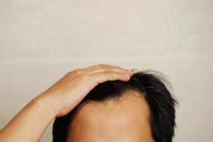 Careca homens e cinzento cabelo estão causou de estresse. foto