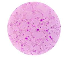 crônica mieloide leucemia ou cml dentro acelerado Estágio com trombocitose. crônica mielógeno leucemia. foto