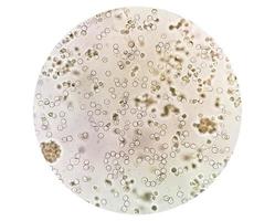 piúria ou leucocitúria é a condição do urina contendo branco sangue células ou pus. isto pode estar uma placa do uma bacteriano urinário trato infecção foto