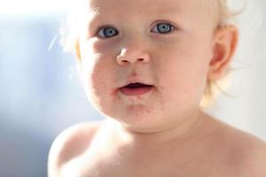 retrato do uma bebê com uma erupção cutânea perto a boca. enterovírus, alergia dentro uma miúdo. foto