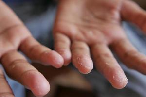 close-up da pele seca e rachada da mão de um homem foto
