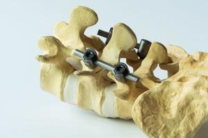 modelo do instrumento fixação do lombar coluna vertebral foto