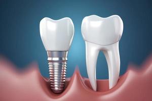 realista dental implantar. dentes tratamento. gerar ai foto