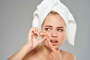mulher com uma toalha em dela cabeça acne em dela face dermatologia pele Cuidado foto