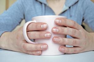 unhas com branco pontos e listras. leuconíquia, opaco branco descoloração do unhas foto