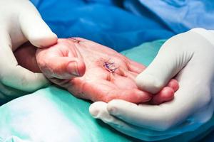 cirurgião sutura a mão do uma paciente às a fim do cirurgia foto