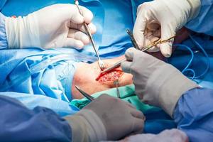grupo do ortopédico cirurgiões realizando cirurgia em uma paciente braço foto