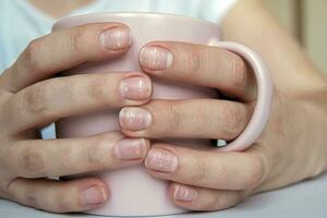 muitos branco pontos em unhas leuconíquia vencimento para cálcio deficiência ou estresse. fêmea mãos segurando caneca foto