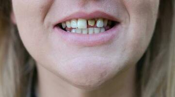 mulher sorrir com uma mau dente. dentes antes tratamento. fechar-se. foto