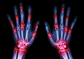 filme de raio-x nas mãos humanas e artrite em múltiplas articulações da gota reumatóide foto