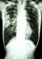 radiografia de tórax mostra infiltrado alveolar no pulmão direito devido a infecção por Mycobacterium tuberculosis tuberculose pulmonar foto