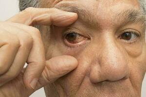 Senior homem com uma Rosa olho infecção dentro 1 do dele olhos foto