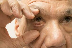 Senior homem com uma Rosa olho infecção dentro 1 do dele olhos foto