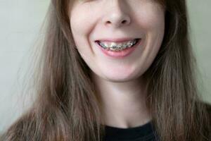 mulher sorrir com dental suspensórios para corrigir a overbite fechar-se. corrigindo torto dentes com ferro suspensórios foto