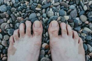 homens nu pés em molhado de praia pedrinhas - era pontos em a pele depois de mar queimadura de sol foto