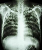 filme de tuberculose pulmonar radiografia de tórax mostra infiltração intersticial em ambos os pulmões devido à infecção por Mycobacterium tuberculosis foto