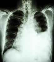 filme radiografia de tórax pa vertical mostra derrame pleural no pulmão esquerdo devido a câncer de pulmão foto