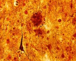 Emaranhados neurofibrilares da doença de Alzheimer e placas senis foto