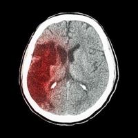 ct cérebro mostra hipodensidade de acidente vascular cerebral isquêmico na área parietal frontal direita foto