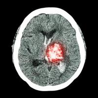 ct cérebro mostra acidente vascular cerebral hemorrágico com hemorragia talâmica esquerda foto