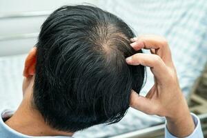 careca na cabeça do meio e começar sem perda de cabelo glabro de homem de escritório ativo inteligente de negócios asiáticos maduros. foto