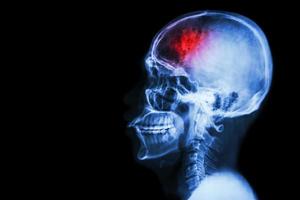 acidente vascular cerebral acidente vascular cerebral filme raio X do crânio lateral com acidente vascular cerebral e área em branco no lado esquerdo foto