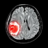 ressonância magnética mostra tumor cerebral no lobo parietal direito do cérebro foto