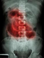 filme de obstrução do intestino delgado raio x abdômen em decúbito dorsal mostra dilatação do intestino delgado devido à obstrução do intestino delgado