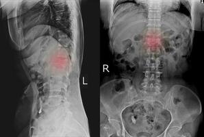 raio X ls coluna vertebral ap lateral achando moderado compressão fratura do l1 vértebra. foto