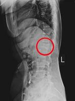 raio X ls coluna vertebral lateral achando moderado compressão fratura do l1 vértebra. foto