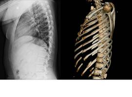 raio X e ct Varredura torácica coluna vertebral foto