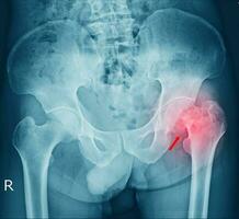 filme raio X uma masculino pélvis fratura e artrite às esquerda quadril articulação foto