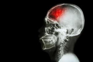 acidente vascular cerebral acidente vascular cerebral. filme radiografia lateral do crânio com derrame e área em branco no lado esquerdo