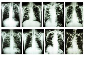 coleção de tuberculose pulmonar por raio-x de tórax foto