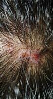 crostas em a couro cabeludo, ferida em a escalpos ou líquen plano folicularis capillitii, coceira em a escalpos foto