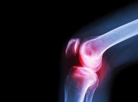 filme de raio-x da articulação do joelho com artrite foto