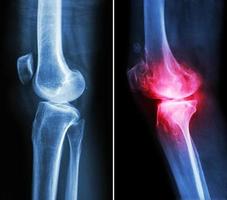 joelho normal e joelho com osteoartrite foto
