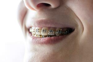 dental suspensórios em dentes do adolescente menina fechar-se foto
