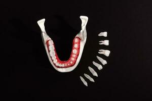 dentes implantar e coroa instalação processo partes isolado em uma Preto fundo. medicamente preciso 3d modelo. foto