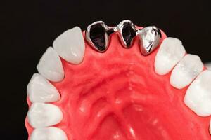 dentes implantar e coroa instalação processo partes isolado em uma azul fundo. medicamente preciso 3d modelo. foto