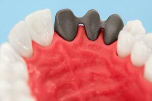 dentes implantar e coroa instalação processo partes isolado em uma azul fundo. medicamente preciso 3d modelo. foto