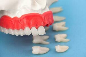 dentes implantar e coroa instalação processo partes isolado em uma azul fundo. medicamente preciso 3d modelo. foto