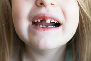 uma pequeno fofa menina perdido dela frente bebê leite dente. perdido temporário dente. foto