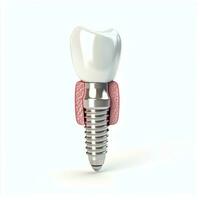 fechar acima do uma dental dente implantar ou saudável humano dentes. branco esmalte e dental implantes cirurgia conceito de ai gerado foto