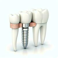 fechar acima do uma dental dente implantar ou saudável humano dentes. branco esmalte e dental implantes cirurgia conceito de ai gerado foto