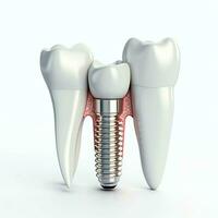 fechar acima do uma dental dente implantar ou saudável humano dentes. branco esmalte e dental implantes cirurgia conceito de ai gerado foto