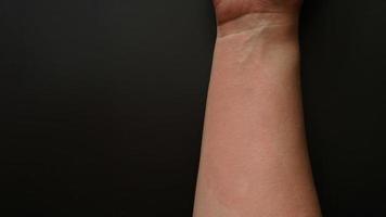 mão feminina coberta com manchas vermelhas, close-up. reação alérgica foto