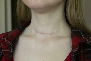 cicatriz depois de cirurgia em mulher pescoço foto