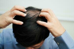 Careca cabeça dentro homem, cabelo perda tratamento saúde problema. foto